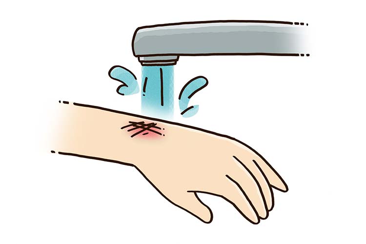 やけどのイメージ画像